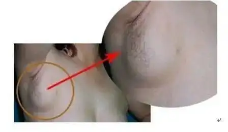 乳腺结节是什么下一步会发展成乳腺癌吗