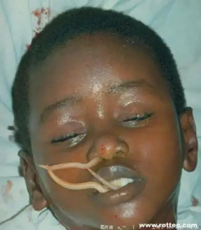 人体内的8种寄生虫图赏_生物探索