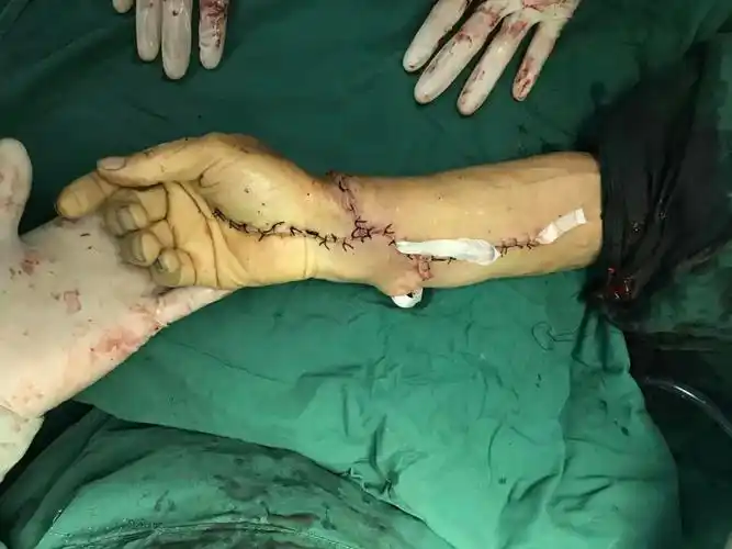 很快,断臂再植手术开始进行.