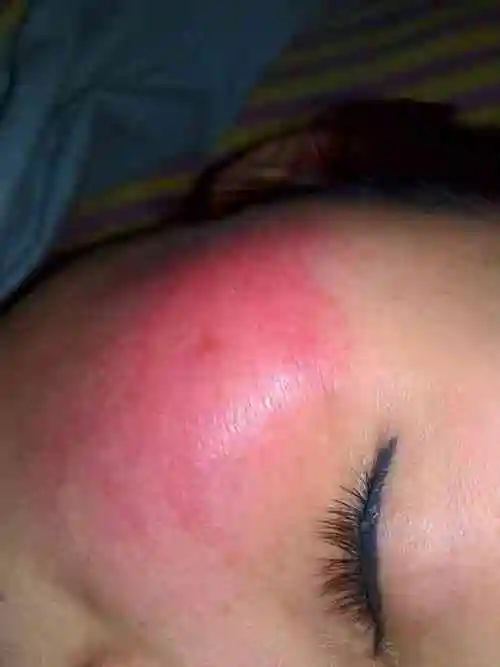 两侧脸颊就出现红肿,和小籽籽……请问:这是过敏的症状吗?