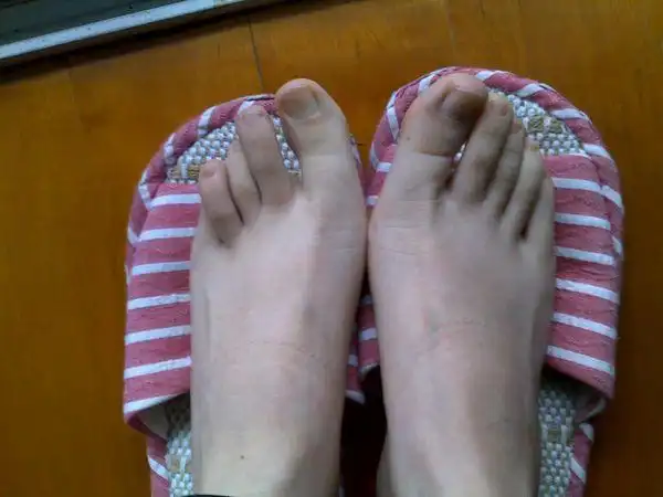 我脚趾头畸形 这个还可以矫正吗