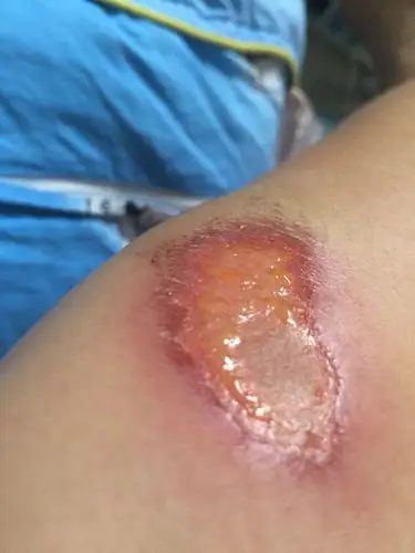 走路摔伤后有膝盖擦伤,因为没有忌口和碰水了,导致伤口化脓,现在敷了