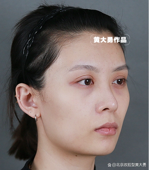 24岁小姐姐下颌角术后4个月 方圆脸秒变瓜子脸