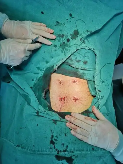 急性腰椎骨折经皮复位钉棒内固定术