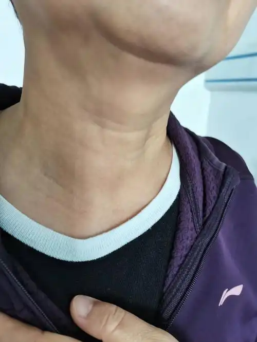 甲状腺结节_甲状腺结节治疗方式 - 好大夫在线