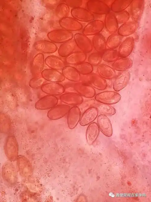 肝吸虫卵如此高清照片赶快收藏