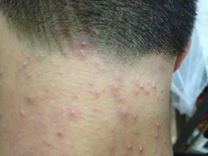 急急急.一天内脖子后面长满小脓包.小脓包刺痒刺痒的.