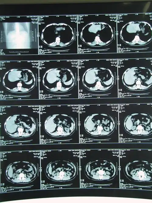 同事的ct片子,疑诊肝癌,请各位同道讨论