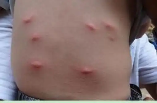 得了疥疮生活中该做好哪些看护工作