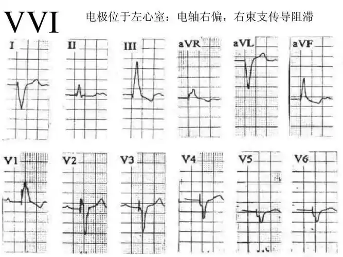 vvi 电极位于左心室:电轴右偏,右束支传导阻滞