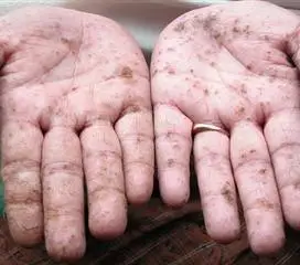 重金属中毒的症状重金属中毒早期症状染发重金属中毒怎么办万能胶干了