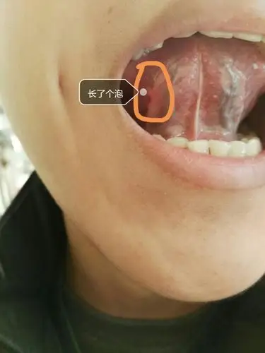舌头下面长了个泡该怎么治疗呢?