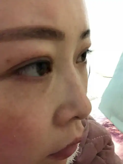 眼窝脂肪填充2个月了,左眼填了1.4,右眼1.2._圈子-新氧美容整形