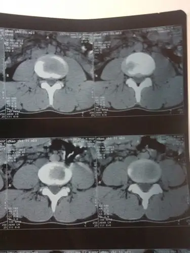 我去医院拍了片子说我腰椎间盘突出当时医生解释我没听明白我就听明白