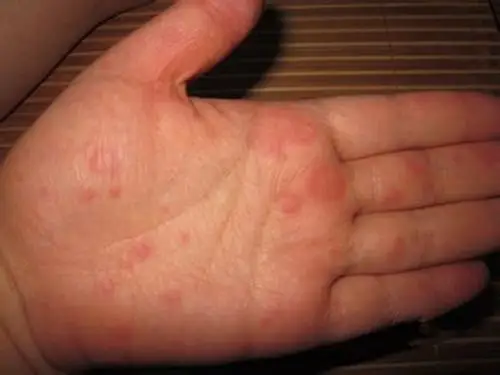 男性一期梅毒图片6