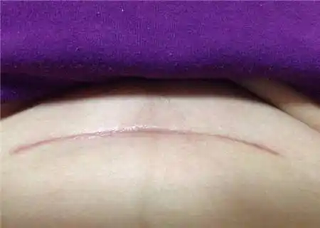 剖腹产的横切和顺产的侧切哪个恢复早四个不同决定结果