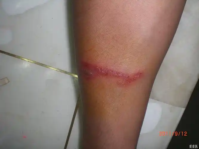 求解无名肿毒影子虫咬伤最后诊断隐翅虫皮炎良版913