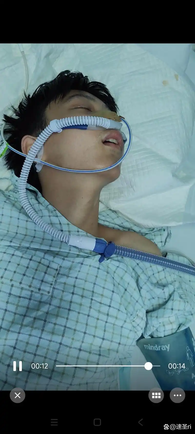 我小孩于五月23日在学校从宿舍楼摔下来,一度在重症监护室,今天才出来