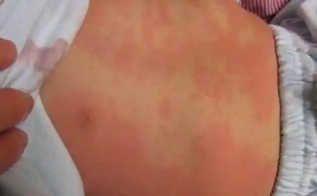 小孩身体发生3个变化,多半是甲醛中毒的信号!不要粗心大意了