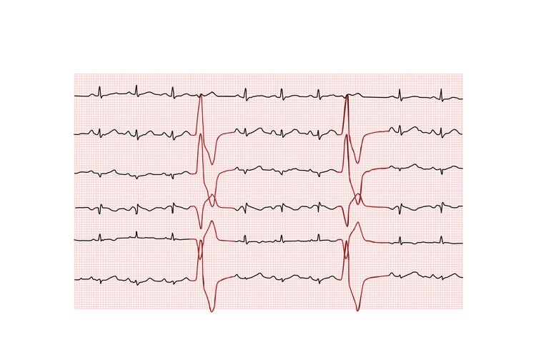 早搏的心电图波形_39健康网_精编内容