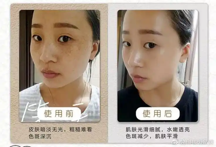 晒斑是不会自己淡化的,皮肤在被阳光中的紫外线照射后,会受到一定程度