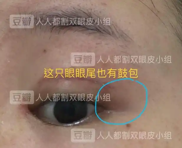 4.7全切双眼皮 眼角处有一个肿肿的小包鼓起来是什.