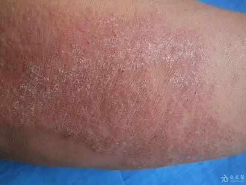 体癣一例 - 皮肤及性传播疾病讨论版 - 爱爱医医学论坛