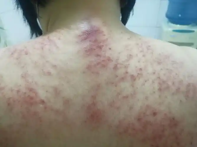 背部刮痧,可以看出一个人的身体健康状况!