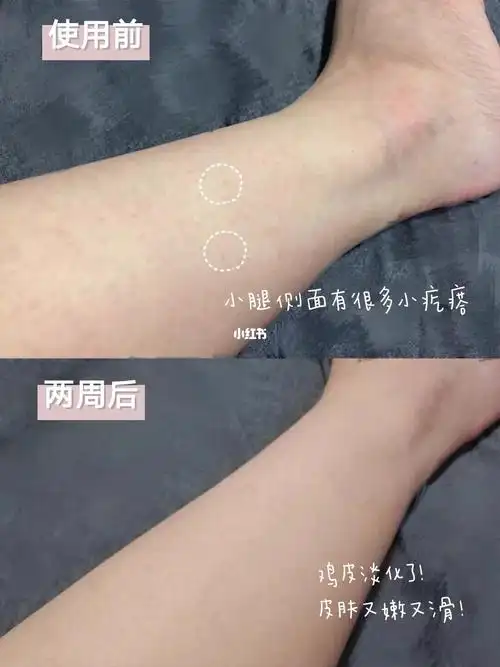 腿比脸还嫩_果酸_磨砂膏_去鸡皮_补水保湿_颗粒_鸡皮肤_去角质_身体乳