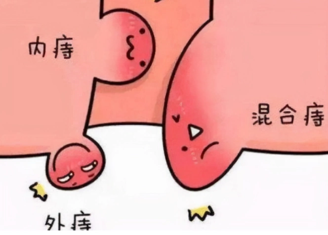 肛门处的"肉疙瘩"不一定是痔疮,医生:可能是这3个原因导致