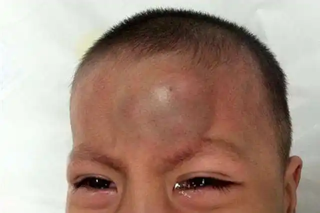 3岁以下的孩子头部受伤的概率很高,因为他们头站身体的比例较大,重心