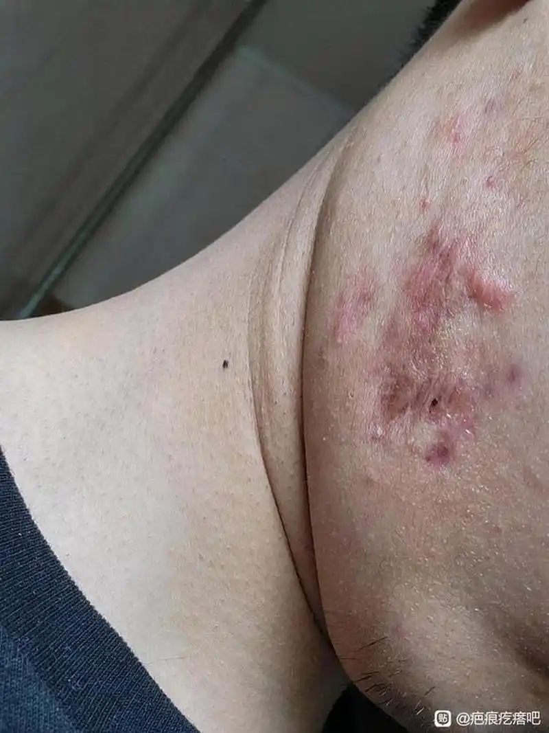 瘢痕疙瘩增生-治疗过程-1 #瘢痕疙瘩# #健康经验笔记# #疾病治疗经验