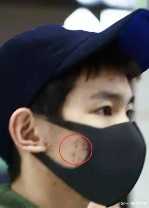 前就有王源大粉爆出他的生图照,即使是用口罩遮面依旧难掩脸上的痘痘