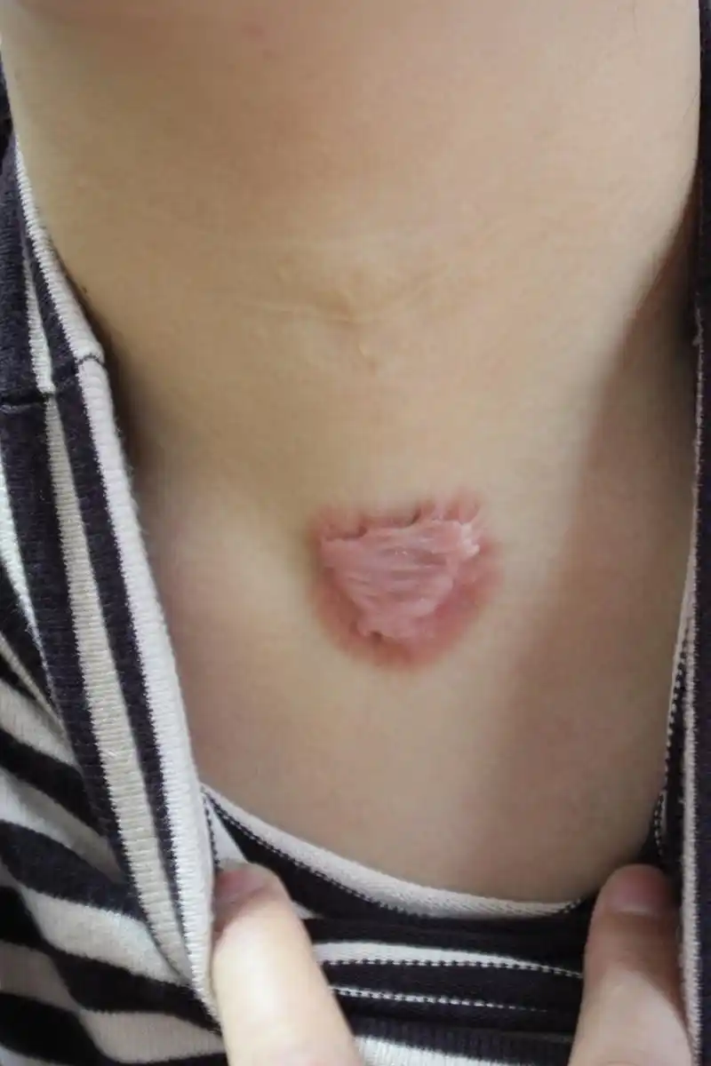 增生性疤痕与瘢痕疙瘩的该怎么办?