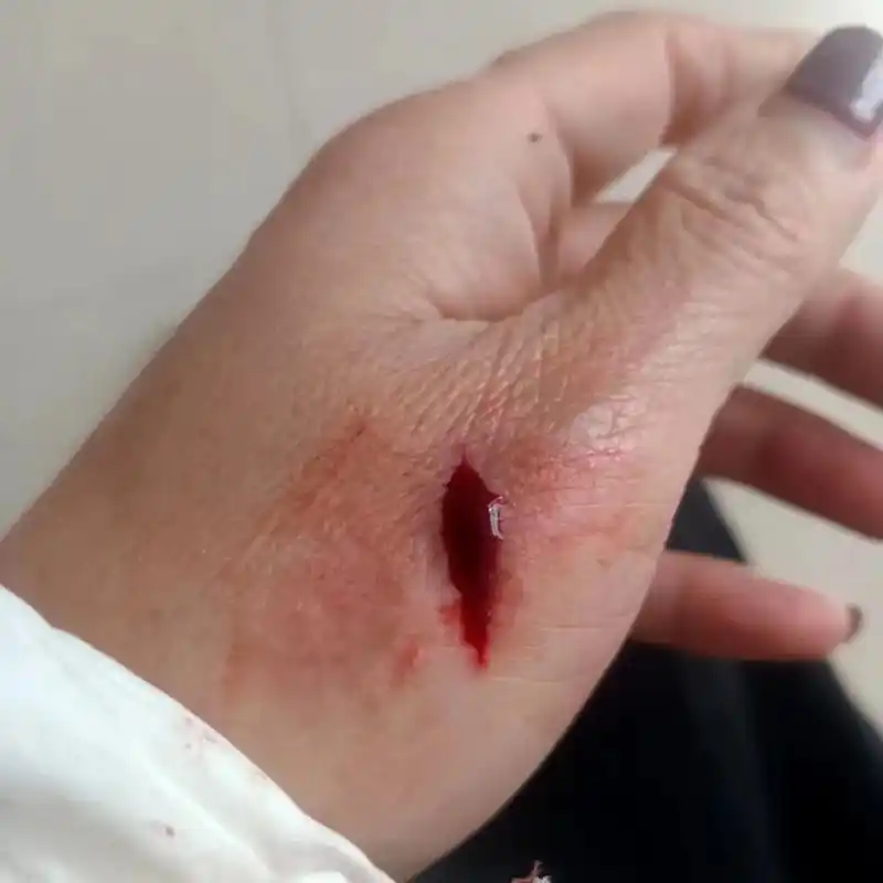 俗话说:见血破灾  但愿是个好兆头吧 一不小心割破了手 虽然 - 抖音