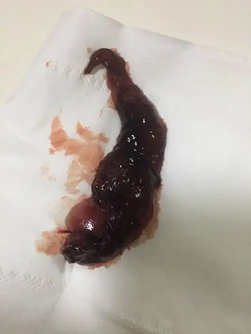 尝试自然流产的患者在组织排出后最好留存照片,旁边放打火机当做参照