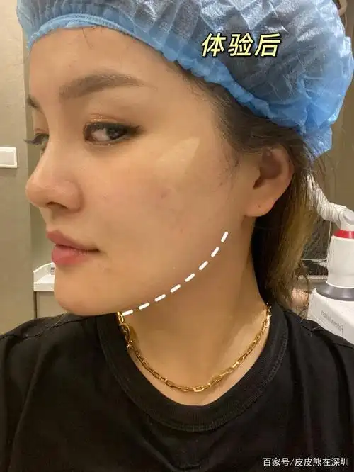 fotona4d单模式|下颌缘提升真的值得做吗?