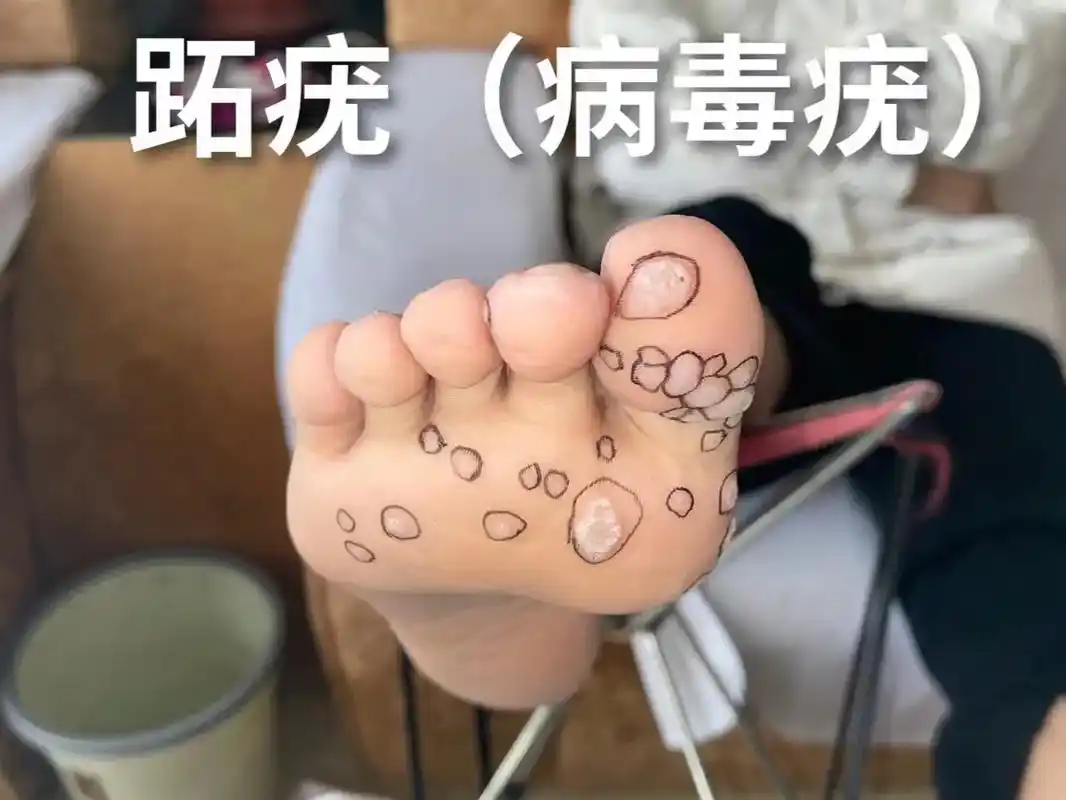 顺鑫手足护理:跖疣(病毒疣)包药效果#手足护理 #足部护理 - 抖音