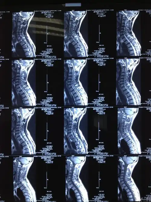 3年前在外院行颈椎椎板切除侧块螺钉内固定术,术后症状症状稍改善,现