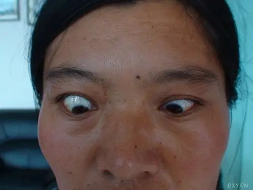 【眼眶病讨论】年轻女性眼球突出,请求确诊和治疗