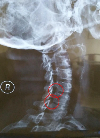 椎间孔改变导致颈椎疼痛 [病例帖]