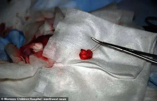 俄罗斯13岁男孩睾丸内长出牙齿 医生称"极其罕见"