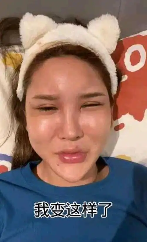 网红"桃花宝宝"整容后遗症:脸像"天鹅头",嘴变"大香肠"