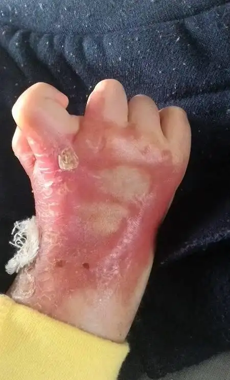 儿童烫伤疤痕_疤痕增生治疗-可丽尼治疗儿童烧烫伤疤痕