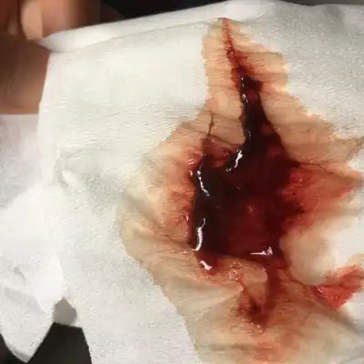 6周流了5天血,见图,是生化了吗?保胎药还要继续吃吗?