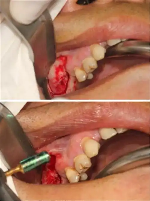 【病例分享】上颌窦大囊肿外提升