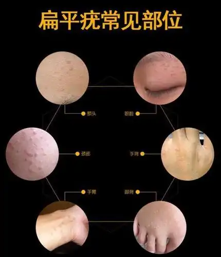 hpv感染与扁平疣_扁平疣_介绍_症状表现_如何预防 - 好大夫在线