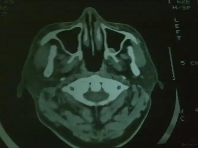 看看上颌窦是什么?