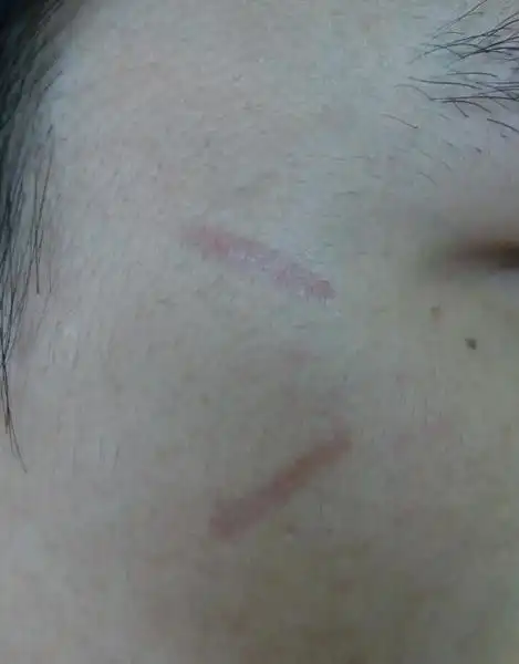 对付表浅凹陷性疤痕有新招点阵激光治疗