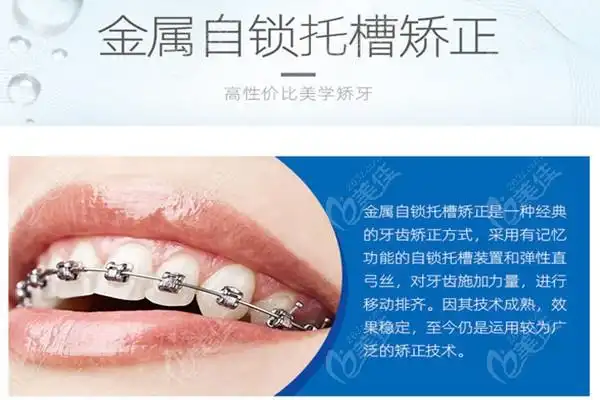 金属自锁托槽矫正